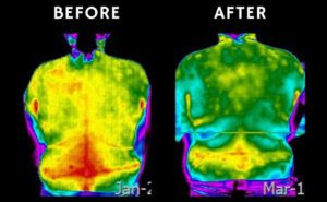 before and after chiropractic thermal image