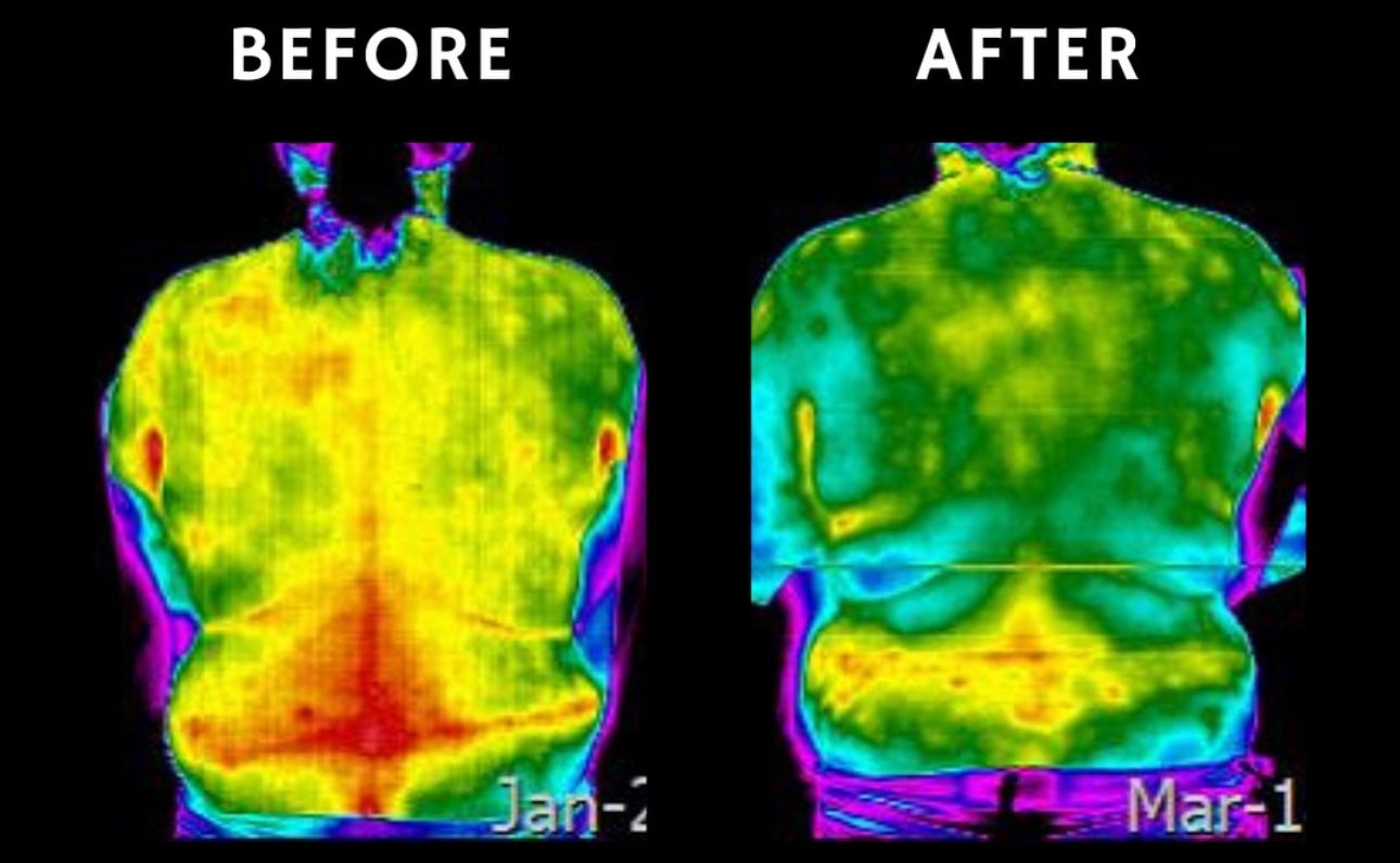 Thermal scan of a patient's back at Life Charge Chiropractic