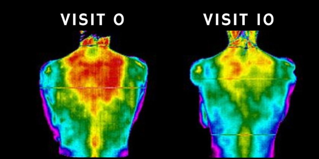 before and after 10 visits chiropractic thermal image